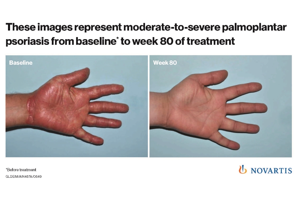 Novartis psoriasis treatment shows strong results
